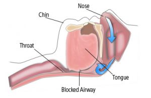 mixed sleep apnea